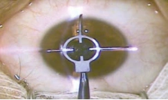 Awwad three-blade CLEAR marker centred on a cornea, shown in Ziemer’s published surgical technique.
